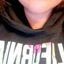 5 hours post juvaderm plus filler on both top and bottom lip 5 hours post juvaderm plus filler on both top and bottom lip