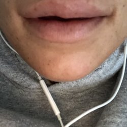 Serious asymmetry after lip fillers with Rosa at CNY