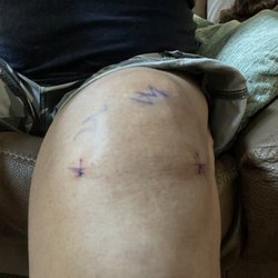 Ryan S Labovitch, MD -  Smart Health and Wellness - Medial meniscus repair. left knee, 72 hours after surgery.
