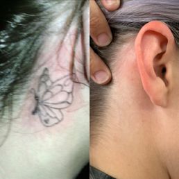 Laser Removal Progress Laser Removal Progress