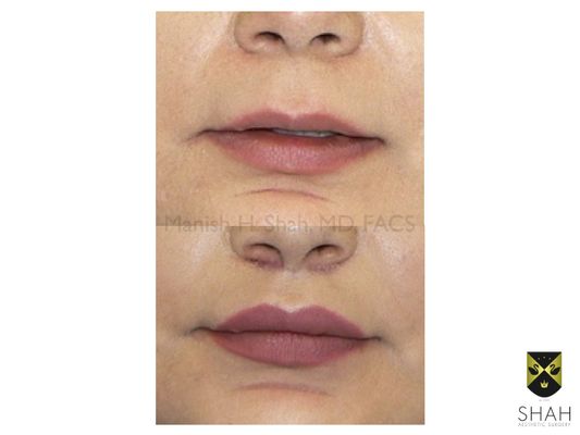 Shah Aesthetic Surgery - Rhinoplasty and Facelift Specialist by null