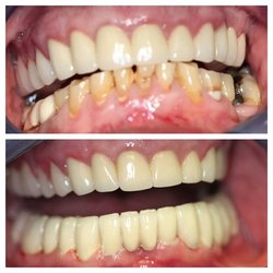 Eklea Cakuli DDS - Full arch reconstruction