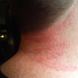 Feels like a sun burn after he spent most of a 20 minute haircut on my neck line. Feels like a sun burn after he spent most of a 20 minute haircut on my neck line.