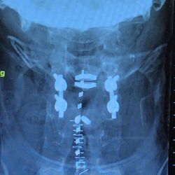 Center for Interventional Pain & Spine - Exton - My cervical spine. Artificial disc. Two broken screw. Titanium on both sides.