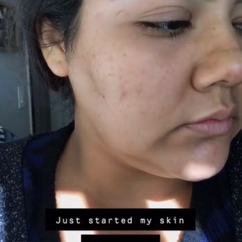 Skin Glow Addict - This is the after photos, my main focus of concern is my cheeks where I have acne and dark spots in the hollow of my cheeks. - Makeup Artists Near Me Skin Glow Addict - This is the after photos, my main focus of concern is my cheeks where I have acne and dark spots in the hollow of my cheeks. - Makeup Artists Near Me