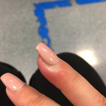 Diva Nails - Can see the puss underneath the skin - Nail Salons Near Me - Chula Vista, California