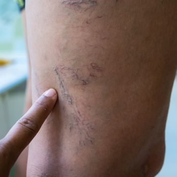 LA Heart and Vascular Center - Varicose veins and spider veins treatment. - Walk-in Clinics Near Me - Downey, California LA Heart and Vascular Center - Varicose veins and spider veins treatment. - Walk-in Clinics Near Me - Downey, California