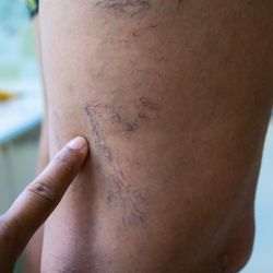LA Heart and Vascular Center - Varicose veins and spider veins treatment.