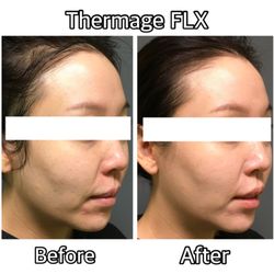 Bloom Medical Aesthetics - Thermage Contact us for further information