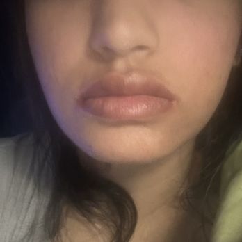 NakedMD - Versa lip filler at the two week mark - Medical Spas Near Me - Mission Viejo, California