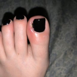 Infected toe two days after!! Infected toe two days after!!