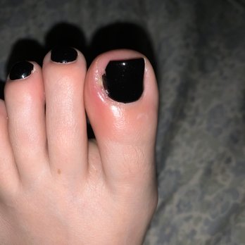 Love Kim Nails - Infected toe two days after!! - Nail Salons Near Me - Peoria, Arizona Love Kim Nails - Infected toe two days after!! - Nail Salons Near Me - Peoria, Arizona