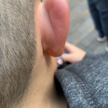 Mini Mansion - Ear swollen from bedbug bites - Bed & Breakfast Near Me - Los Angeles, California Mini Mansion - Ear swollen from bedbug bites - Bed & Breakfast Near Me - Los Angeles, California