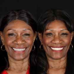 Scott Young - Smile makeover using veneers, crowns, and dental implants