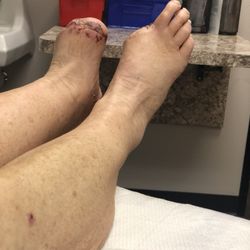 Nevada Heart & Vascular Center - This is what happened to my husband because of Nevada Vascular!