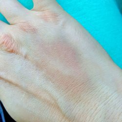 Burst vain created a bubble like a gumball under my skin. Today swollen, bruised. EVERY TIME at this place. Never an issue anywhere else.