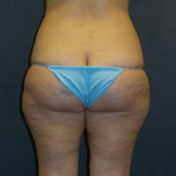 Eric P Bachelor, MD, FACS - Female, 41 yr old BEFORE LIPOSUCTION