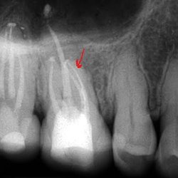 Endodontics - He found the little branch here. This is so tiny it's mindblowing