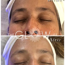 The Glow Life - Before & After HydraFacial