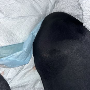 Diamond Post Care - Did not want to wash my FAJA or change paddings because it was 2am.  I often slept in my own blood and incision discharge. Caused infection - Bed & Breakfast Near Me - Miami, Florida