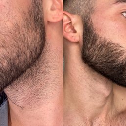 Neck hair without shaving before & after laser treatments Neck hair without shaving before & after laser treatments