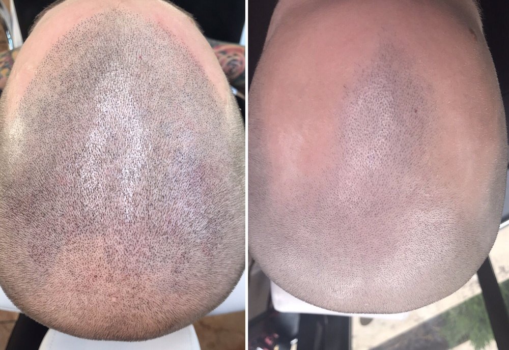THE SCALP BARBER SCALP MICROPIGMENTATION BY ALLURE 621 Capitol Mall