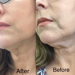 Revive Aesthetics & Wellness Center - Before and after Ultherapy &cheek filler