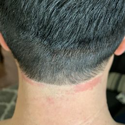 My irritated neck after haircut... My irritated neck after haircut...