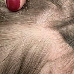 Headhunters Hair Design - Bald spot