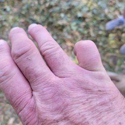 Exer Urgent Care - Costa Mesa - Dislocated pinky finger could not straighten it out.