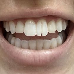 Main Street Dentistry: Roya Levi, DDS - This is the PERFECTLY HEALTHY WRONG TOOTH she drilled through.
