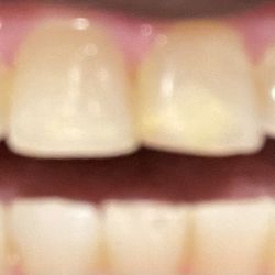 Stockbridge Dental Studio - Patch work ruff and discolored after third attempt and must cost.