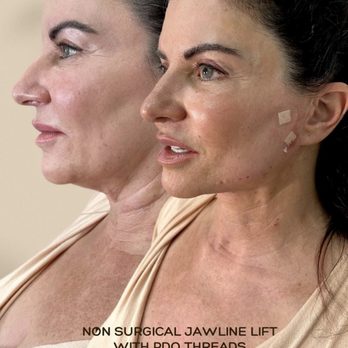 ST Med Spa - A thread lift is a procedure that uses a dissolvable suture to tighten and lift your skin. It's a less invasive procedure than surgery - Medical Spas Near Me - Encino, California ST Med Spa - A thread lift is a procedure that uses a dissolvable suture to tighten and lift your skin. It's a less invasive procedure than surgery - Medical Spas Near Me - Encino, California