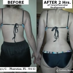 Zenfinity Massage and Wellness - Patient had acute pain in hips and low back, couldn't sit, & was walking with a cane before session.
