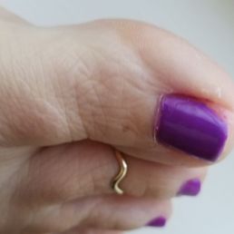 You can see the natural edge where my toenail WAS, and the hard angle left when the tech cut the sides off! I did NOT ask her to do that!
