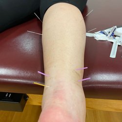 Perrico Health Campus Physical Therapy - Dry needling