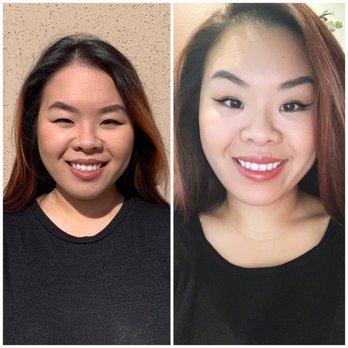 Angell Medical Spa - 12cc of botox in each masseter and 6ccs in my chin. Custom face designed by Dr Angell! - Medical Spas Near Me - Sacramento, California Angell Medical Spa - 12cc of botox in each masseter and 6ccs in my chin. Custom face designed by Dr Angell! - Medical Spas Near Me - Sacramento, California