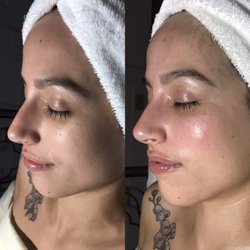 Emerald Esthetic - Before and After Facial