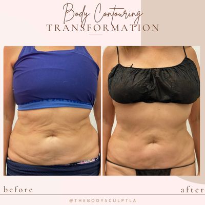 Before and After Transformations - Body Sculpting treatments can help you get the firm and toned looking body you've always dreamed of. Sometimes, no matter how much you have exercised and dieted, there's still those jiggly ounces of unwanted fatty tissue in the hardest to tone areas. Innovative medical technology now makes it possible to sculpt and refine your figure with non-invasive body contouring treatments.
At The Body Sculpt LA, we can target your loose skin, cellulite, and unwanted fat. We utilize modern and minimally invasive techniques to engage most areas of the body.
Each treatment session will be customized to your unique needs and can include a combination of:
Body Cavitation, Radio Frequency, Vacuum Therapy, and Wood Therapy Before and After Transformations - Body Sculpting treatments can help you get the firm and toned looking body you've always dreamed of. Sometimes, no matter how much you have exercised and dieted, there's still those jiggly ounces of unwanted fatty tissue in the hardest to tone areas. Innovative medical technology now makes it possible to sculpt and refine your figure with non-invasive body contouring treatments.
At The Body Sculpt LA, we can target your loose skin, cellulite, and unwanted fat. We utilize modern and minimally invasive techniques to engage most areas of the body.
Each treatment session will be customized to your unique needs and can include a combination of:
Body Cavitation, Radio Frequency, Vacuum Therapy, and Wood Therapy
