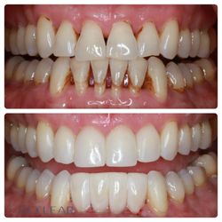 Masterful Dentistry of Livermore - Bioclear to close black triangles caused by recession.