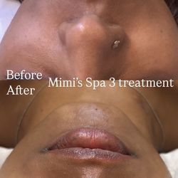 Mimi's Spa - Chemical Peel - dark skin complexion