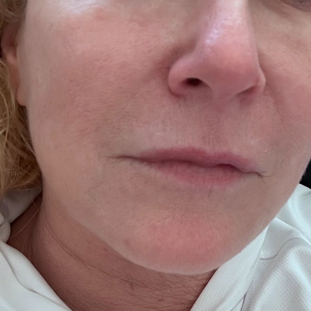 Rejuve Med Spa - No makeup or filters - Medical Spas Near Me - Foothill Ranch, California Rejuve Med Spa - No makeup or filters - Medical Spas Near Me - Foothill Ranch, California
