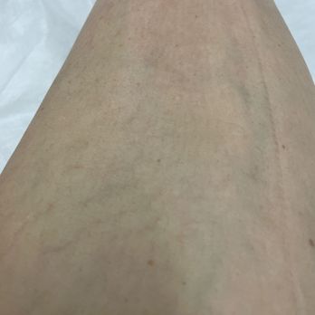 New You Laser - I haven't shaved in months since the beginning of the summer! - Laser Hair Removal Near Me - New York, New York