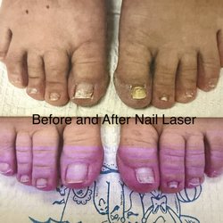 Michael R. Cook, Podiatry - Before and after nail laser treatments