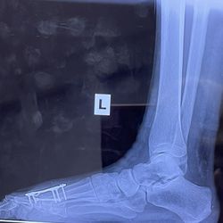 Ankle & Foot Centers of America - My results after surgery,