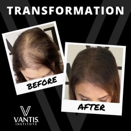 Hair Loss and VFR Hair Loss and VFR