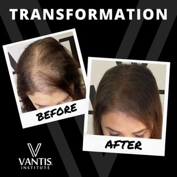 Vantis Institute - Hair Loss and VFR - Hair Loss Centers Near Me - Newport Beach, California Vantis Institute - Hair Loss and VFR - Hair Loss Centers Near Me - Newport Beach, California