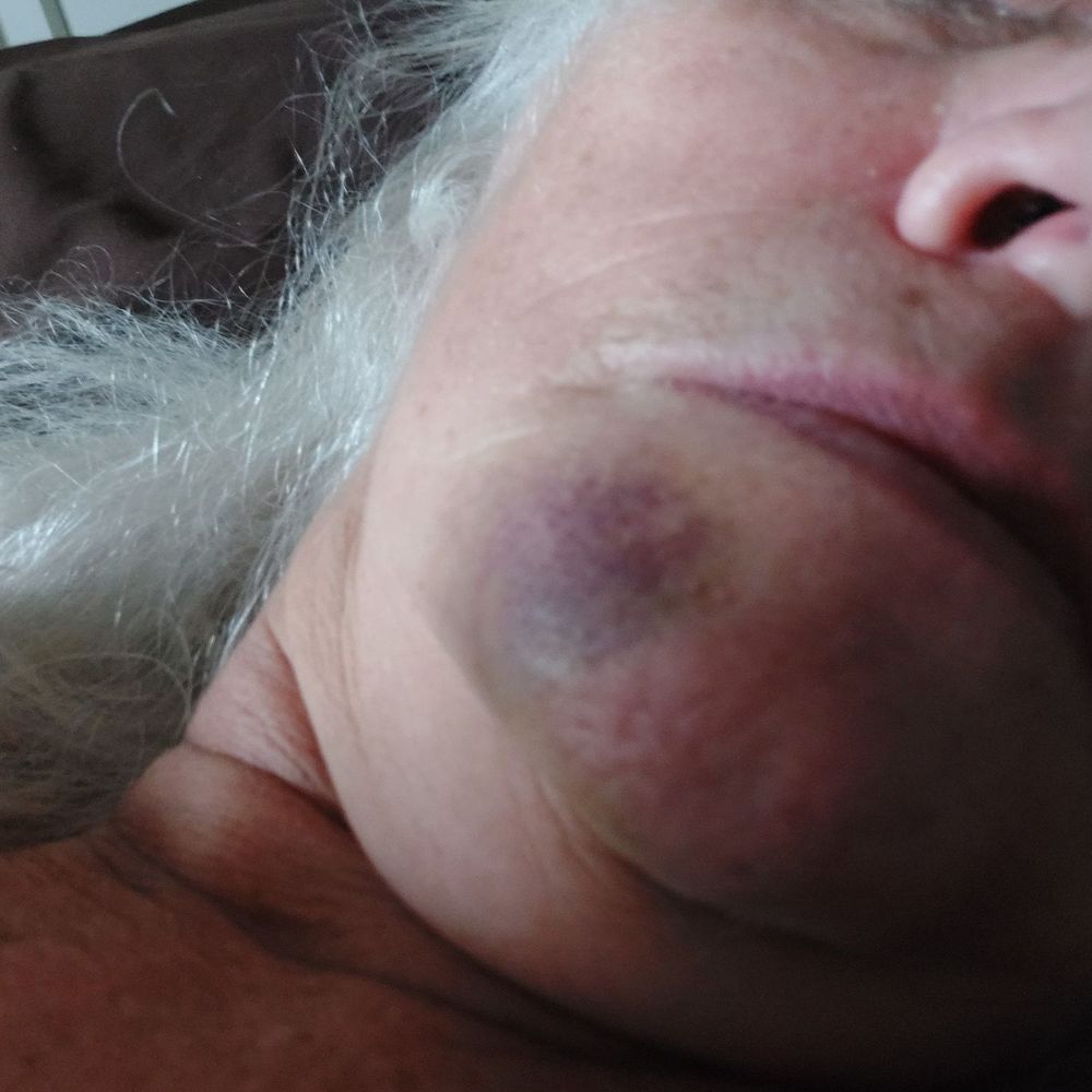 Aspen Dental - My bruise on the outside of my mouth. - General Dentistry Near Me - Daytona Beach, Florida Aspen Dental - My bruise on the outside of my mouth. - General Dentistry Near Me - Daytona Beach, Florida