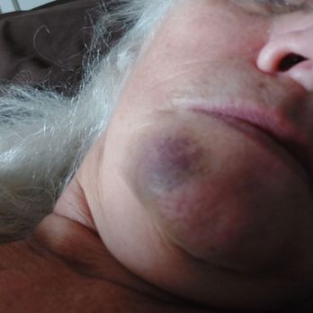 Aspen Dental - Daytona Beach, FL - My bruise on the outside of my mouth. - General Dentistry Near Me - Daytona Beach, Florida
