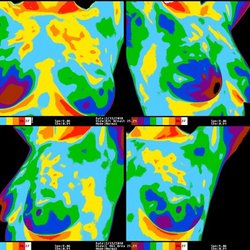 Pacific Naturopathic - Breast Thermography at Pacific Naturopathic